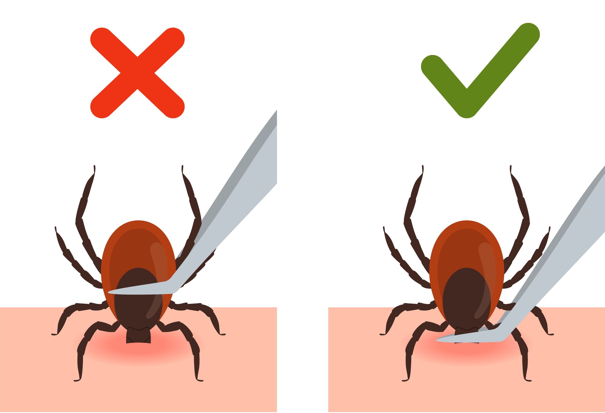 An illustration of how to remove a tick properly, ensuring you get as close to the mouth as possible, rather than squeezing the head. Image: Getty