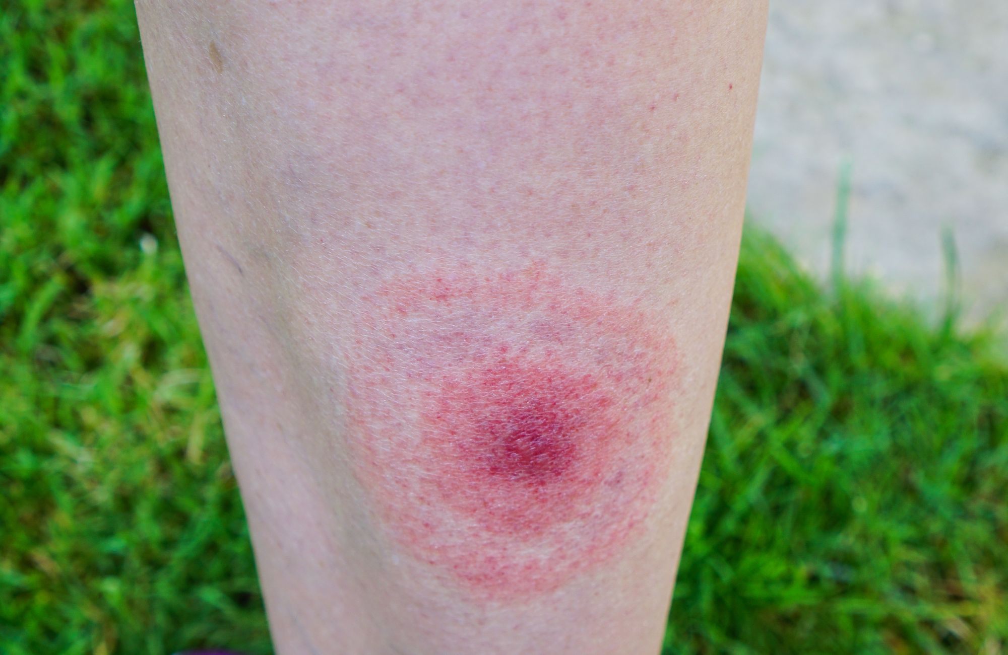 An example of a bullseye rash. You should see the GP immediately if you get one. Photo: Getty